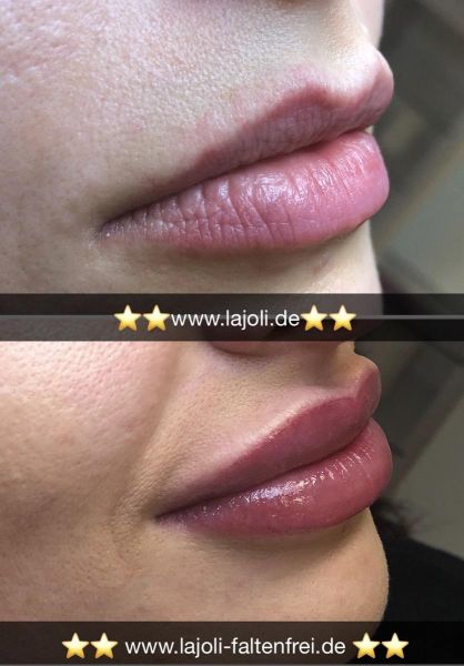 Lippen Permanent Make Up kombinieren mit Lippen aufspritzen mit Hyaluronsäure