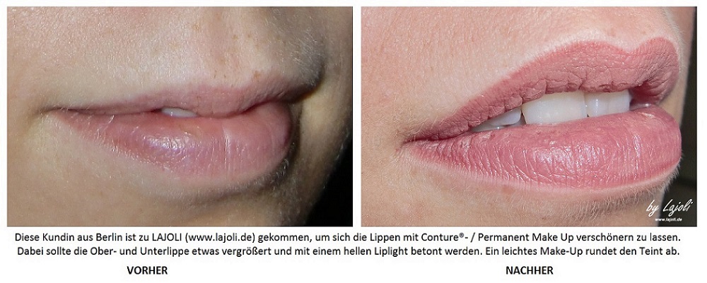 LAJOLI Permanent Make Up / Kosmetik Hamburg - Faltenunterspritzung / Fadenlifting - Lippen aufspritzen - Kundin aus Berlin