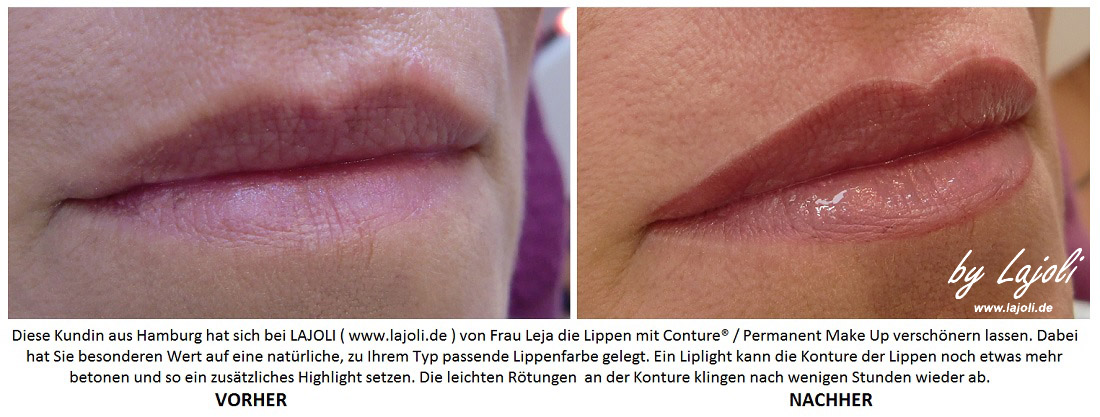 LAJOLI Permanent Make Up Bilder - Faltenunterspritzung / Fadenlifting - Lippen aufspritzen - Hamburg